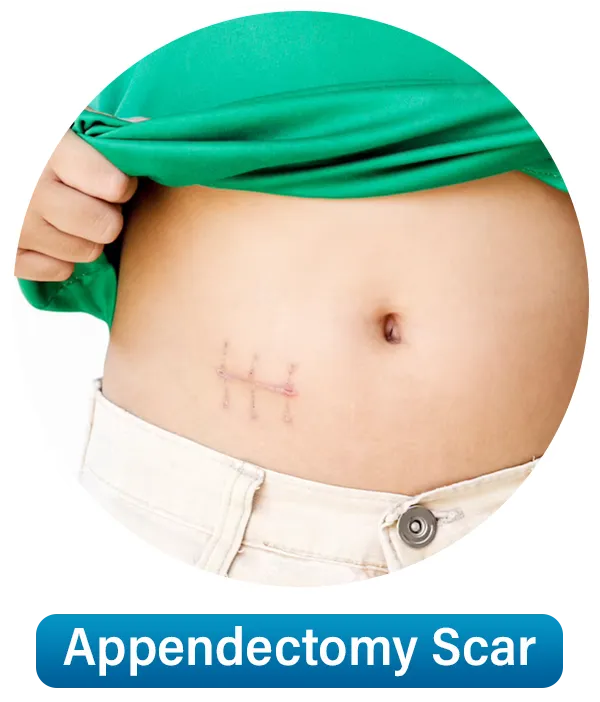 Appendectomy-Scar1