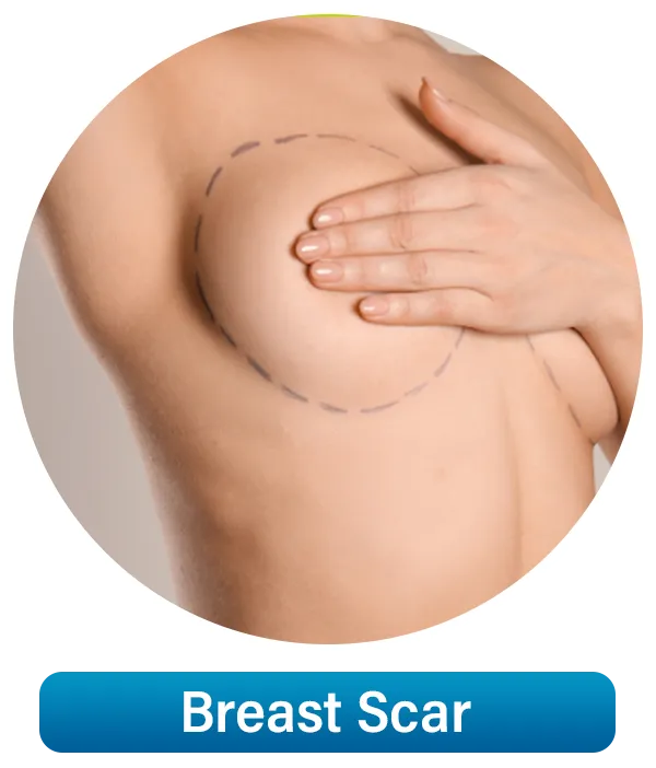 Breast-Scar1