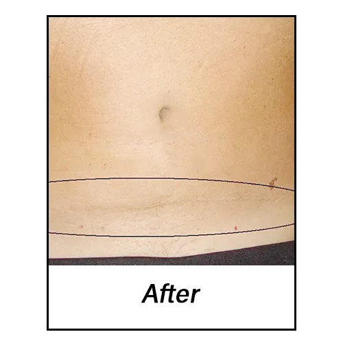 C-Section-After