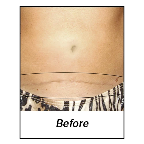 C-Section-Before