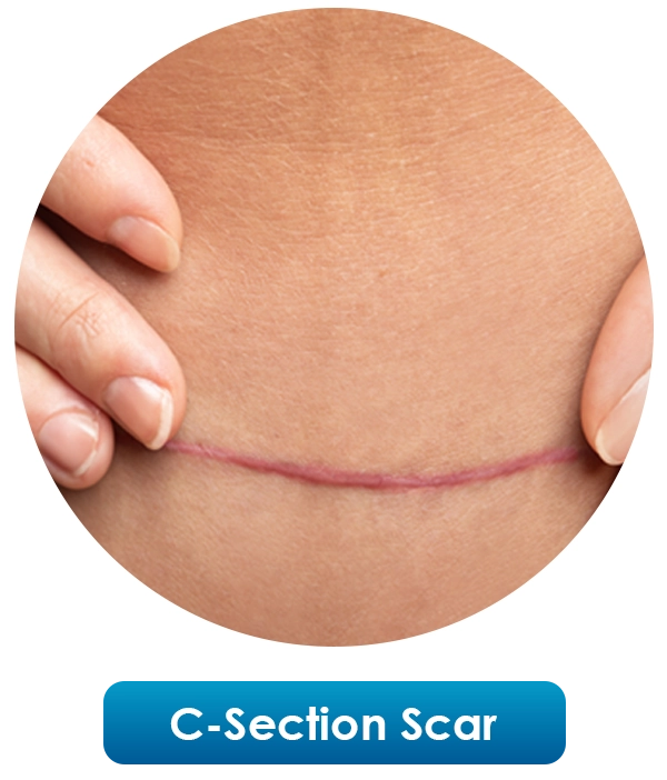 C-Section