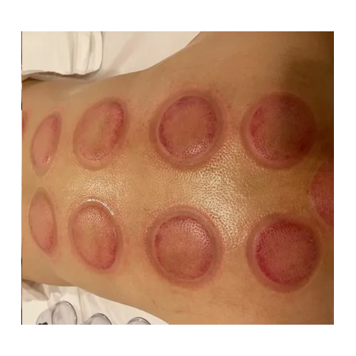Cupping-Therapy3