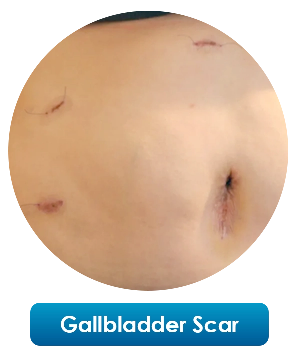 Gallbladder-Scar