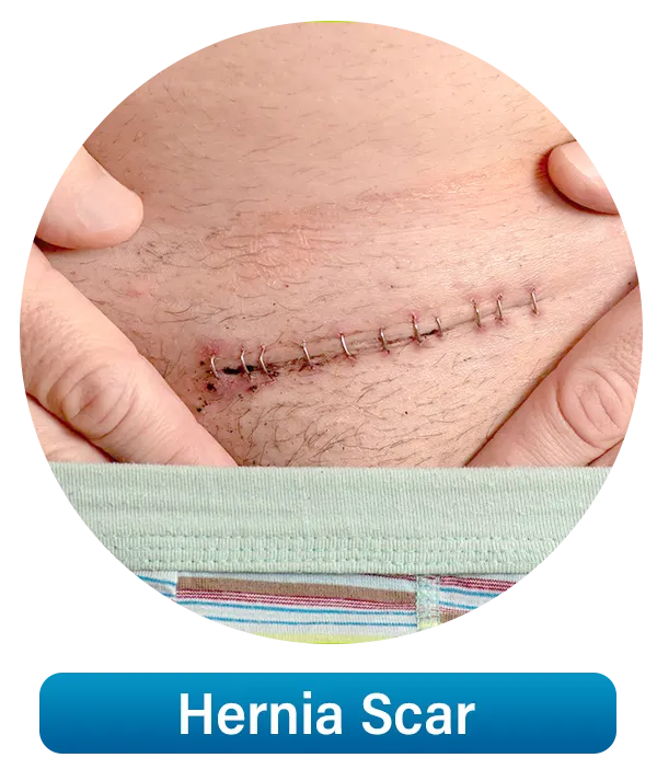 Hernia-Scar1