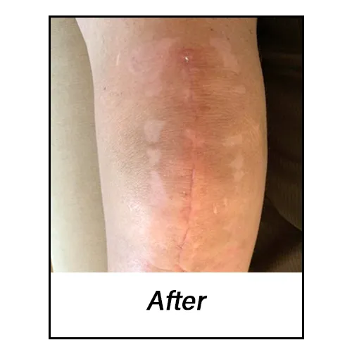 Knee_After