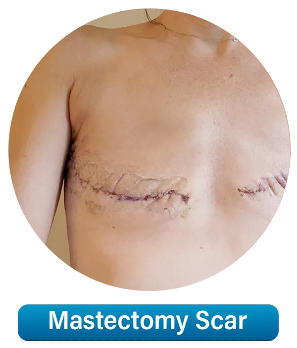 Mastectomy-Scar1